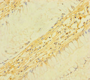 Immunohistochemistry of paraffin-embedded human colon cancer using CSB-PA023620LA01HU at dilution of 1:100