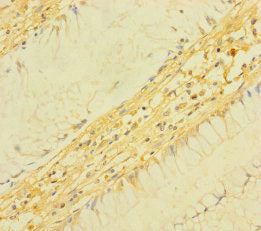 Immunohistochemistry of paraffin-embedded human colon cancer using CSB-PA023620LA01HU at dilution of 1:100