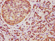 IHC image of CSB-PA023720LA01HU diluted at 1:350 and staining in paraffin-embedded human pancreatic cancer performed on a Leica BondTM system. After dewaxing and hydration, antigen retrieval was mediated by high pressure in a citrate buffer (pH 6....