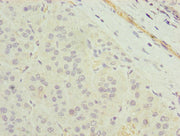 Immunohistochemistry of paraffin-embedded human liver cancer using CSB-PA023759LA01HU at dilution of 1:100