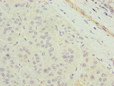 Immunohistochemistry of paraffin-embedded human liver cancer using CSB-PA023759LA01HU at dilution of 1:100