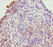 Immunohistochemistry of paraffin-embedded human bladder cancer using CSB-PA023840ESR1HU at dilution of 1:100