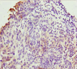 Immunohistochemistry of paraffin-embedded human bladder cancer using CSB-PA023840ESR1HU at dilution of 1:100