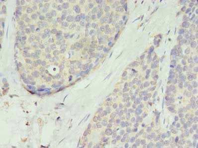 Immunohistochemistry of paraffin-embedded human gastric cancer using CSB-PA023842LA01HU at dilution of 1:100