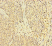Immunohistochemistry of paraffin-embedded human ovarian cancer using CSB-PA023959LA01HU at dilution of 1:100