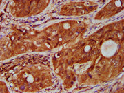 IHC image of CSB-PA023975LA01HU diluted at 1:500 and staining in paraffin-embedded human cervical cancer performed on a Leica BondTM system. After dewaxing and hydration, antigen retrieval was mediated by high pressure in a citrate buffer (pH 6.0)...