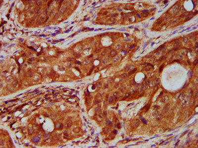 IHC image of CSB-PA023975LA01HU diluted at 1:500 and staining in paraffin-embedded human cervical cancer performed on a Leica BondTM system. After dewaxing and hydration, antigen retrieval was mediated by high pressure in a citrate buffer (pH 6.0)...