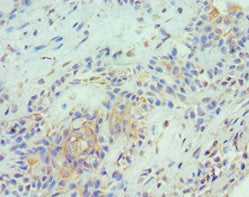 Immunohistochemistry of paraffin-embedded human breast cancer using CSB-PA023989ESR2HU at dilution of 1:100