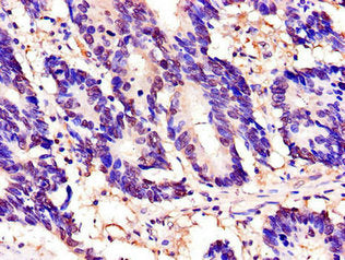Immunohistochemistry of paraffin-embedded human colon cancer using CSB-PA024067LA01HU at dilution of 1:100