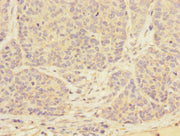 Immunohistochemistry of paraffin-embedded human ovarian cancer using CSB-PA024108ESR2HU at dilution of 1:100