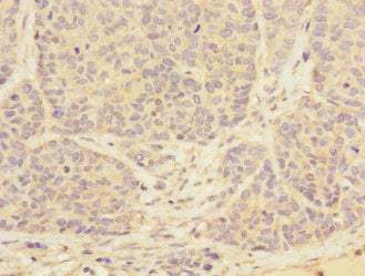 Immunohistochemistry of paraffin-embedded human ovarian cancer using CSB-PA024108ESR2HU at dilution of 1:100