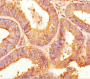 Immunohistochemistry of paraffin-embedded human endometrial cancer using CSB-PA024133LA01HU at dilution of 1:100