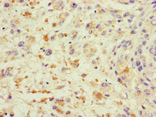 Immunohistochemistry of paraffin-embedded human melanoma using CSB-PA024147LA01HU at dilution of 1:100