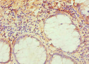 Immunohistochemistry of paraffin-embedded human colon cancer using CSB-PA024150ESR1HU at dilution of 1:100