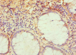 Immunohistochemistry of paraffin-embedded human colon cancer using CSB-PA024150ESR1HU at dilution of 1:100