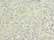Immunohistochemistry of paraffin-embedded human lung cancer using CSB-PA024152ESR1HU at dilution of 1:100