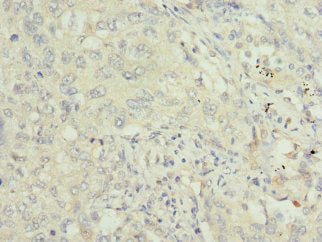 Immunohistochemistry of paraffin-embedded human lung cancer using CSB-PA024152ESR1HU at dilution of 1:100