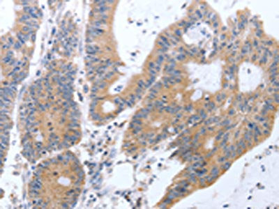 The image on the left is immunohistochemistry of paraffin-embedded Human colon cancer tissue using CSB-PA024203(TAT Antibody) at dilution 1/35, on the right is treated with fusion protein. (Original magnification: ×200)
