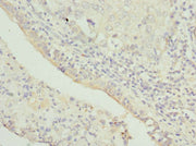 Immunohistochemistry of paraffin-embedded human lung cancer using CSB-PA024226ESR2HU at dilution of 1:100