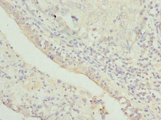 Immunohistochemistry of paraffin-embedded human lung cancer using CSB-PA024226ESR2HU at dilution of 1:100