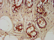 IHC image of CSB-PA024232LA01HU diluted at 1:400 and staining in paraffin-embedded human breast cancer performed on a Leica BondTM system. After dewaxing and hydration, antigen retrieval was mediated by high pressure in a citrate buffer (pH 6.0)....