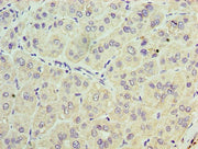 Immunohistochemistry of paraffin-embedded human liver cancer using CSB-PA024291LA01HU at dilution of 1:100