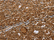 The image on the left is immunohistochemistry of paraffin-embedded Human thyroid cancer tissue using CSB-PA024314(STMN2/STMN3/STMN4 Antibody) at dilution 1/45, on the right is treated with synthetic peptide. (Original magnification: ×200)