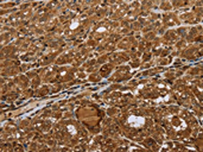 The image on the left is immunohistochemistry of paraffin-embedded Human thyroid cancer tissue using CSB-PA024314(STMN2/STMN3/STMN4 Antibody) at dilution 1/45, on the right is treated with synthetic peptide. (Original magnification: ×200)