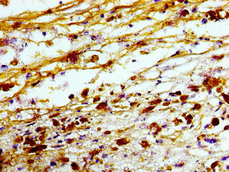 Immunohistochemistry of paraffin-embedded human melanoma using CSB-PA024405LA01HU at dilution of 1:100
