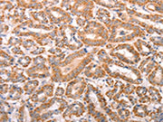 The image on the left is immunohistochemistry of paraffin-embedded Human thyroid cancer tissue using CSB-PA024643(TRPV4 Antibody) at dilution 1/40, on the right is treated with fusion protein. (Original magnification: ×200)