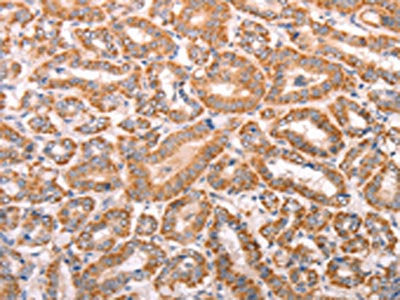 The image on the left is immunohistochemistry of paraffin-embedded Human thyroid cancer tissue using CSB-PA024643(TRPV4 Antibody) at dilution 1/40, on the right is treated with fusion protein. (Original magnification: ×200)