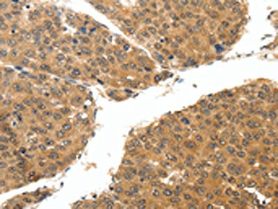 The image on the left is immunohistochemistry of paraffin-embedded Human breast cancer tissue using CSB-PA024834(RUNX3 Antibody) at dilution 1/25, on the right is treated with synthetic peptide. (Original magnification: ×200)