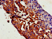 Immunohistochemistry of paraffin-embedded human breast cancer using CSB-PA025075LA01HU at dilution of 1:100