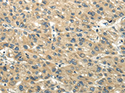 The image on the left is immunohistochemistry of paraffin-embedded Human liver cancer tissue using CSB-PA025080(CHGB Antibody) at dilution 1/40, on the right is treated with synthetic peptide. (Original magnification: ×200)