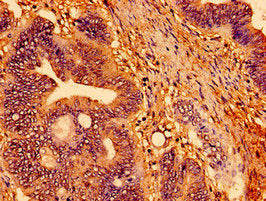 Immunohistochemistry of paraffin-embedded human colon cancer using CSB-PA536576LA01HU at dilution of 1:100