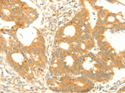 The image on the left is immunohistochemistry of paraffin-embedded Human colon cancer tissue using CSB-PA025221(TRAF3IP2 Antibody) at dilution 1/25, on the right is treated with fusion protein. (Original magnification: ×200)