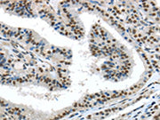 The image on the left is immunohistochemistry of paraffin-embedded Human thyroid cancer tissue using CSB-PA025245(TKT Antibody) at dilution 1/30, on the right is treated with fusion protein. (Original magnification: ×200)