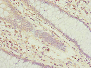 Immunohistochemistry of paraffin-embedded human colon cancer using CSB-PA025351ESR1HU at dilution of 1:100