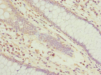 Immunohistochemistry of paraffin-embedded human colon cancer using CSB-PA025351ESR1HU at dilution of 1:100