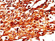 IHC image of CSB-PA025394LA01HU diluted at 1:300 and staining in paraffin-embedded human melanoma performed on a Leica BondTM system. After dewaxing and hydration, antigen retrieval was mediated by high pressure in a citrate buffer (pH 6.0). Secti...
