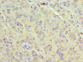 Immunohistochemistry of paraffin-embedded human liver cancer using CSB-PA025405ESR1HU at dilution of 1:100