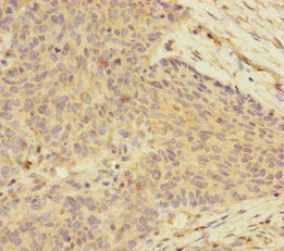 Immunohistochemistry of paraffin-embedded human ovarian cancer using CSB-PA025409ESR2HU at dilution of 1:100