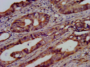 IHC image of CSB-PA025453LA01HU diluted at 1:500 and staining in paraffin-embedded human colon cancer performed on a Leica BondTM system. After dewaxing and hydration, antigen retrieval was mediated by high pressure in a citrate buffer (pH 6.0). S...
