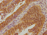 IHC image of CSB-PA025468OA01HU diluted at 1:100 and staining in paraffin-embedded human colon cancer performed on a Leica BondTM system. After dewaxing and hydration, antigen retrieval was mediated by high pressure in a citrate buffer (pH 6.0). S...