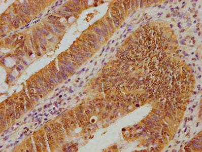IHC image of CSB-PA025468OA01HU diluted at 1:100 and staining in paraffin-embedded human colon cancer performed on a Leica BondTM system. After dewaxing and hydration, antigen retrieval was mediated by high pressure in a citrate buffer (pH 6.0). S...