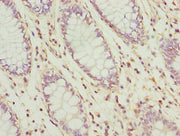 Immunohistochemistry of paraffin-embedded human colon cancer using CSB-PA025498LA01HU at dilution of 1:100