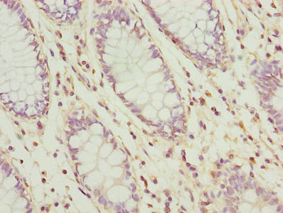 Immunohistochemistry of paraffin-embedded human colon cancer using CSB-PA025498LA01HU at dilution of 1:100