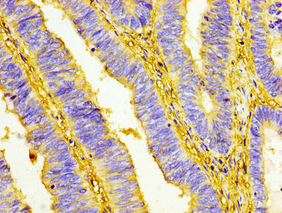 IHC image of CSB-PA025554LA01HU diluted at 1:100 and staining in paraffin-embedded human colon cancer performed on a Leica BondTM system. After dewaxing and hydration, antigen retrieval was mediated by high pressure in a citrate buffer (pH 6.0). S...