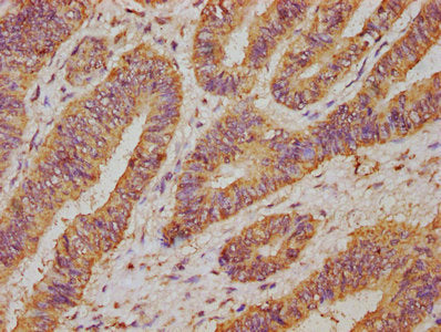 IHC image of CSB-PA025555EA01HU diluted at 1:50 and staining in paraffin-embedded human colon cancer performed on a Leica BondTM system. After dewaxing and hydration, antigen retrieval was mediated by high pressure in a citrate buffer (pH 6.0). Se...