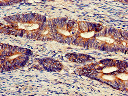 Immunohistochemistry of paraffin-embedded human colon cancer using CSB-PA025560LA01HU at dilution of 1:100